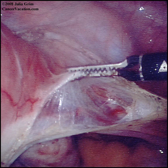 Internal hysterectomy view...