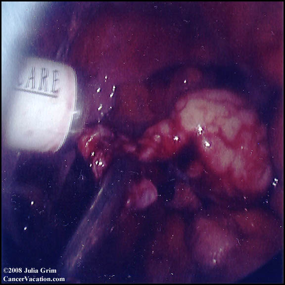 Internal hysterectomy view...