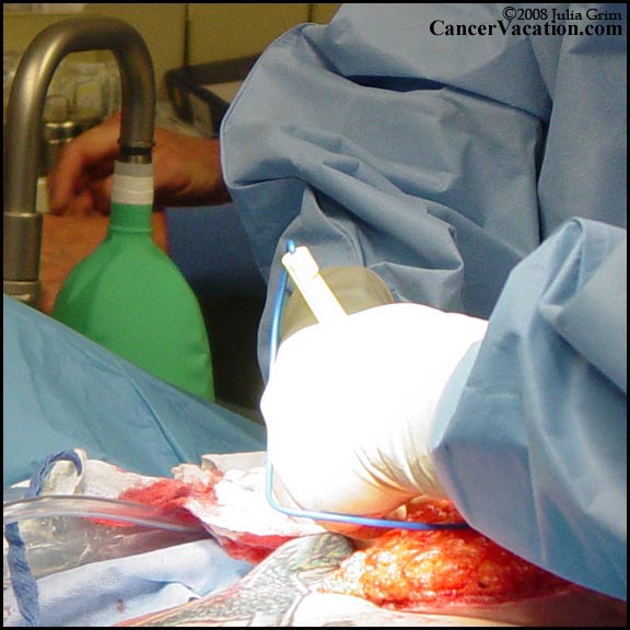 Removal of the left (cancerous) breast tissue...