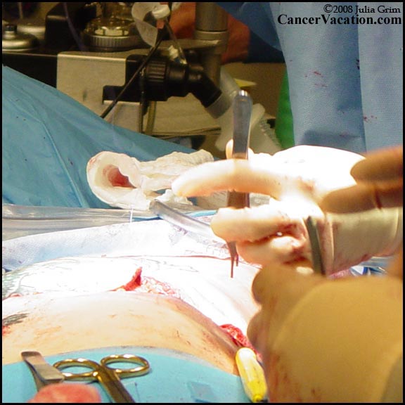 Closing the left-side incision...