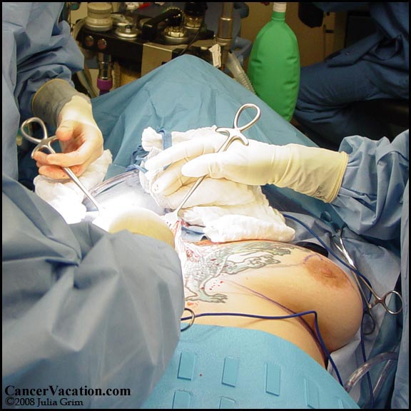 Right breast (non-cancerous) removal...